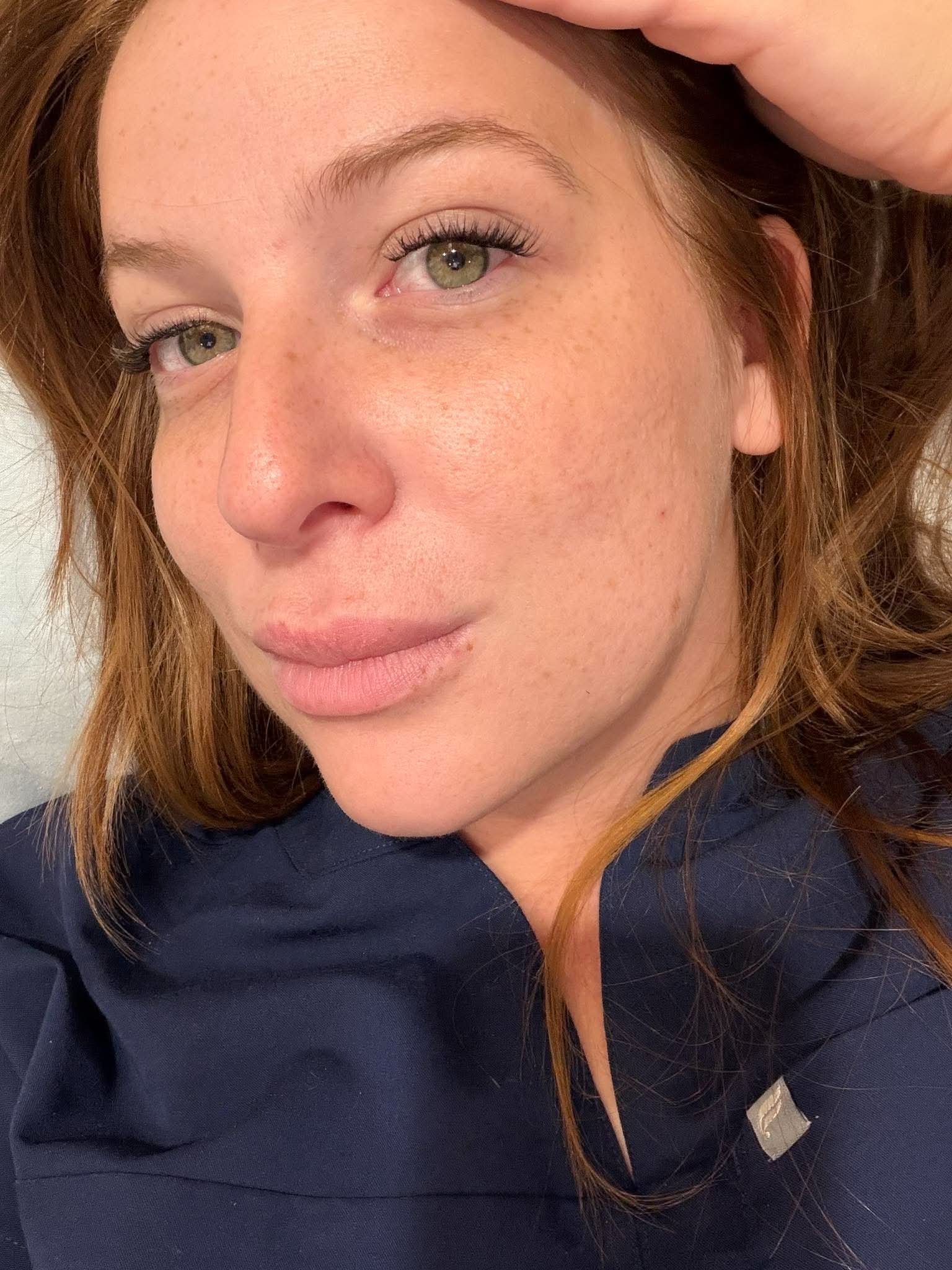 After: skin tone and texture following Laser Genesis / IPL treatment