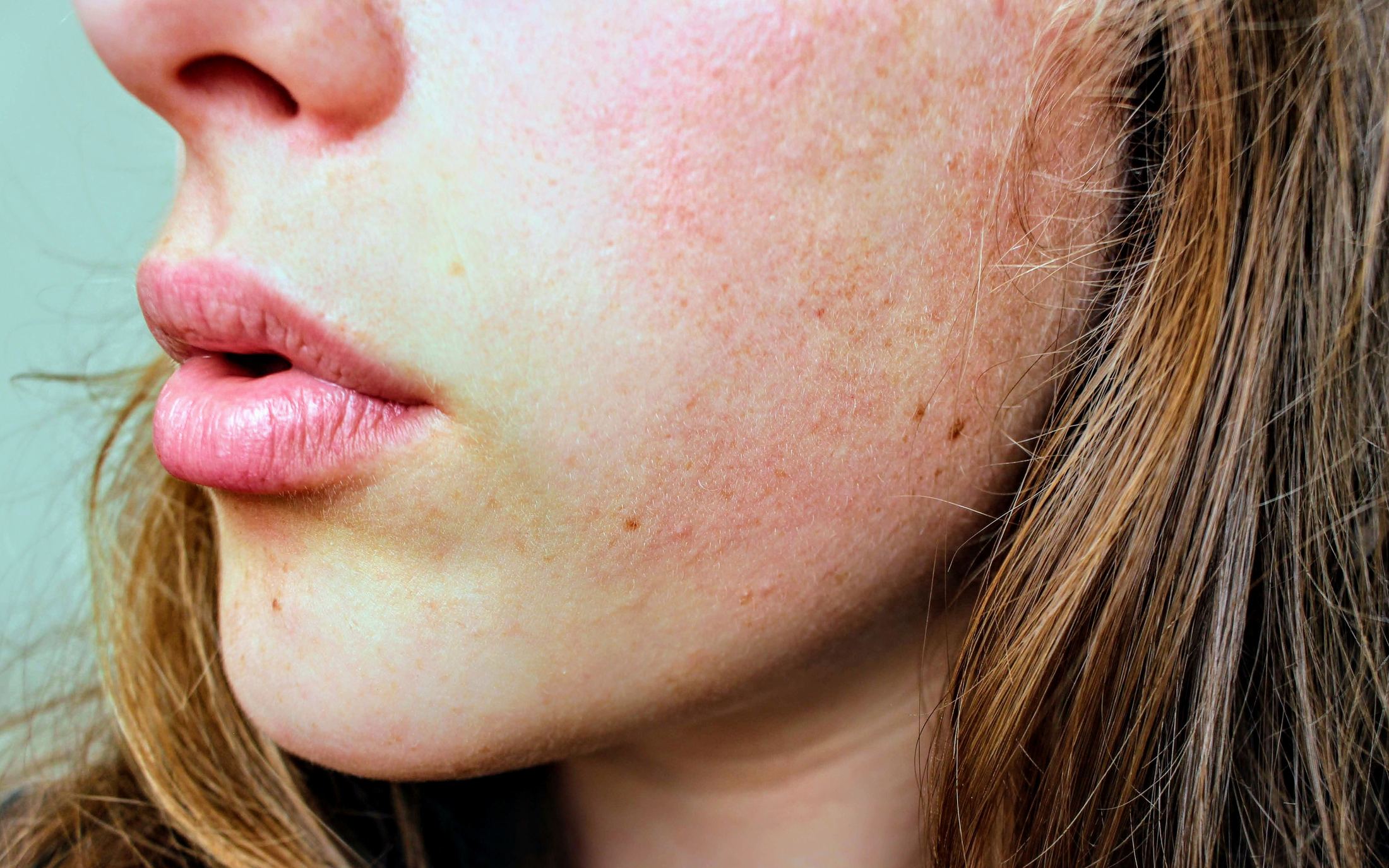 Skin texture and acne scarring treated with laser resurfacing