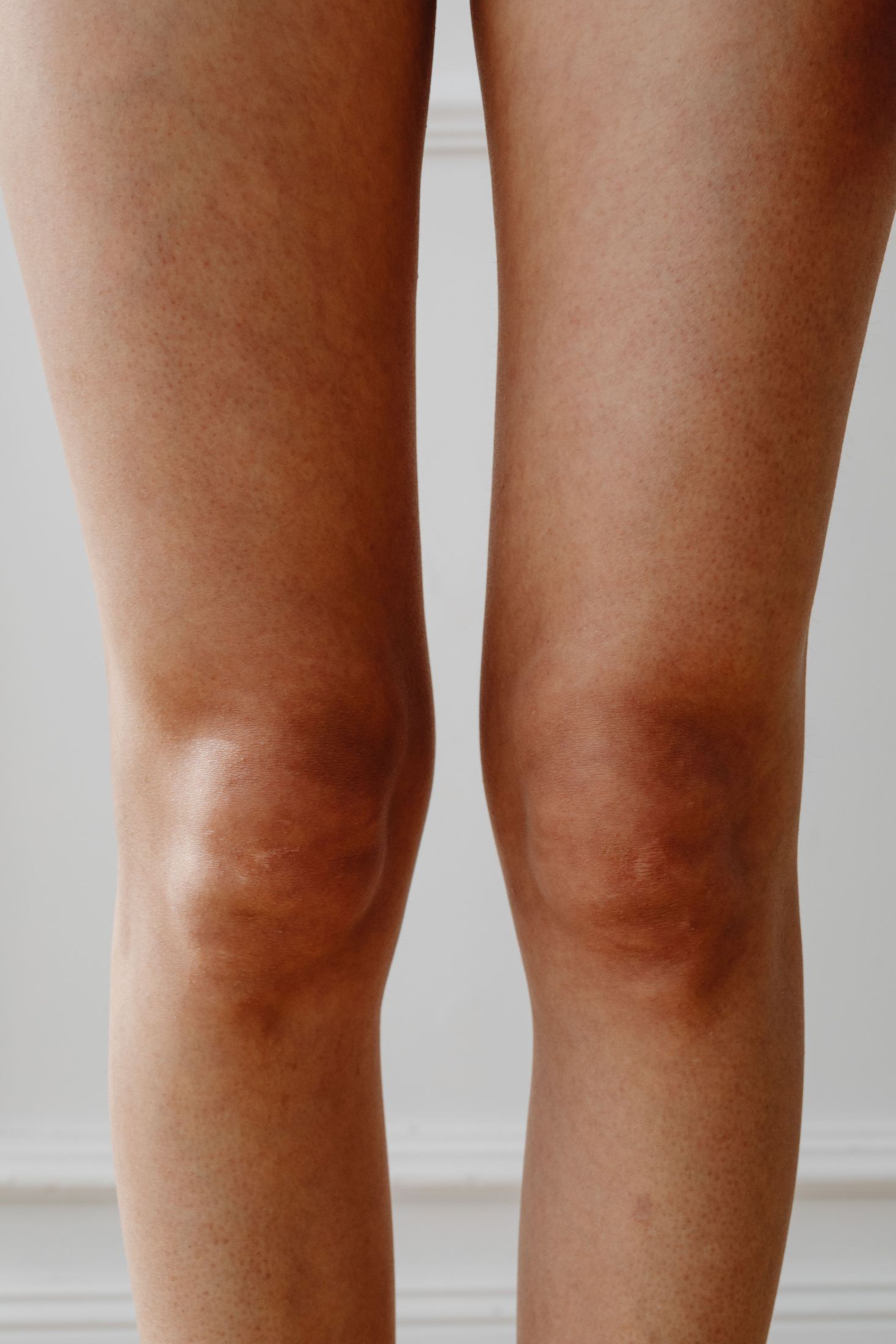 Legs treated with laser vein removal