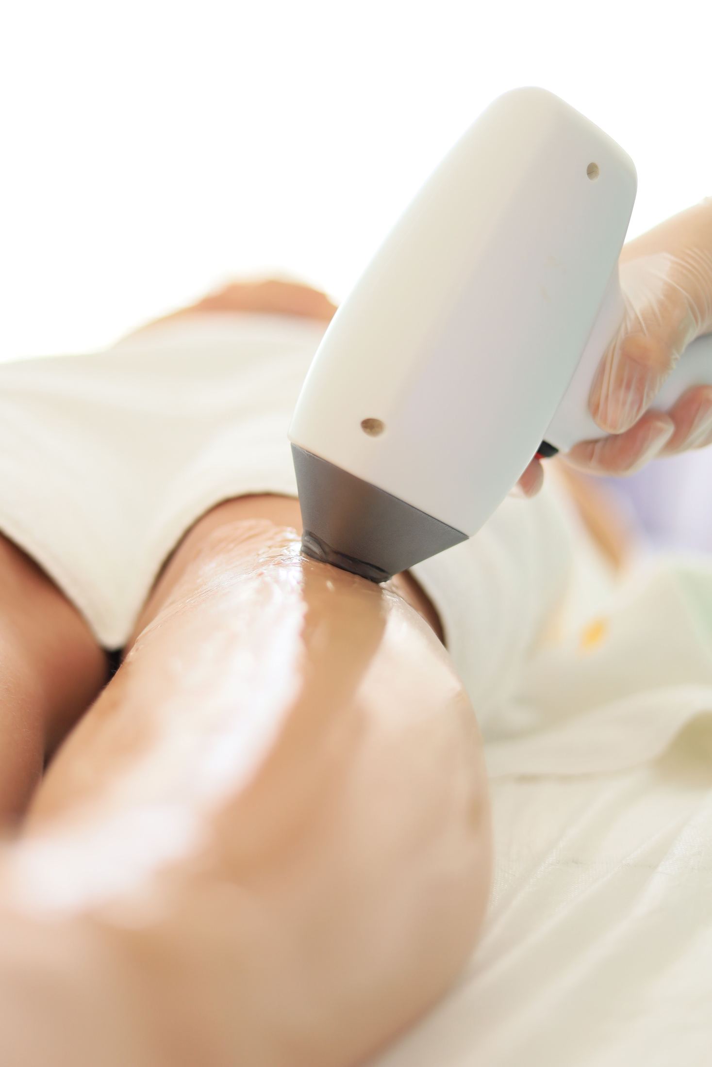 A laser hair removal treatment being performed