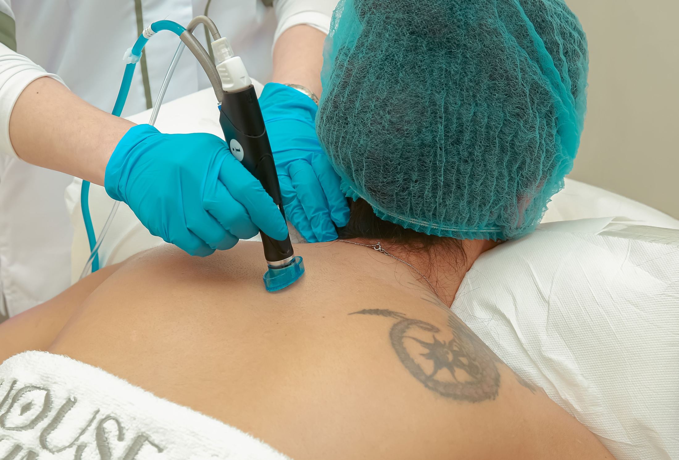 A laser tattoo removal treatment being performed